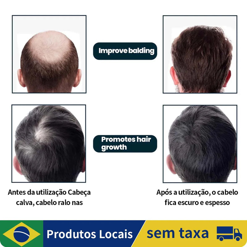 Minoxidil 5% Kirkland - Para 3 meses de Tratamento